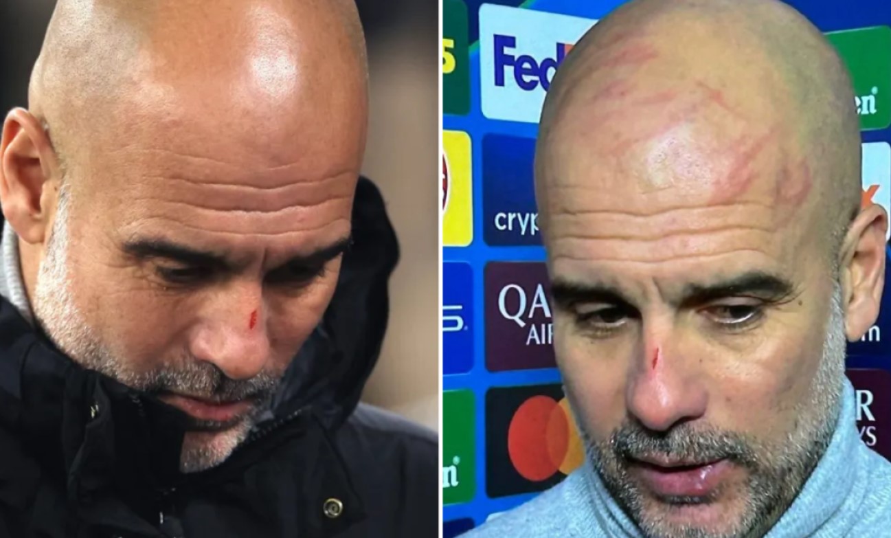 Guardiola došao pred novinare pun ožiljaka i krvavog nosa 