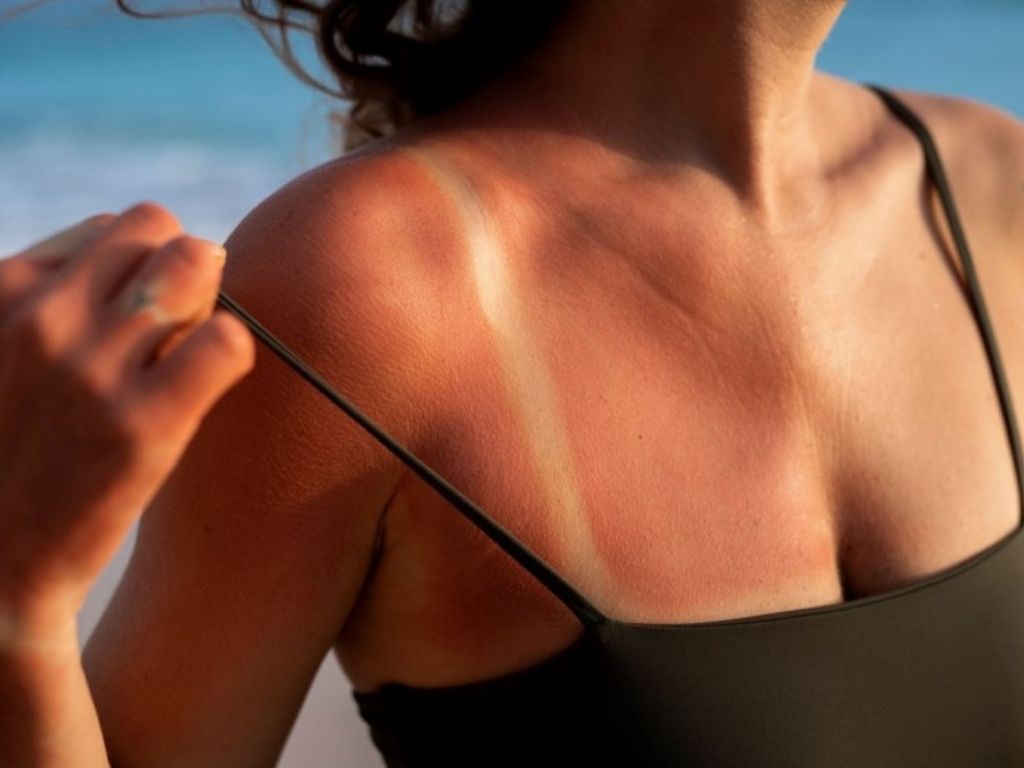 Izgorjeli ste na suncu? Dermatolozi daju korisne savjete
