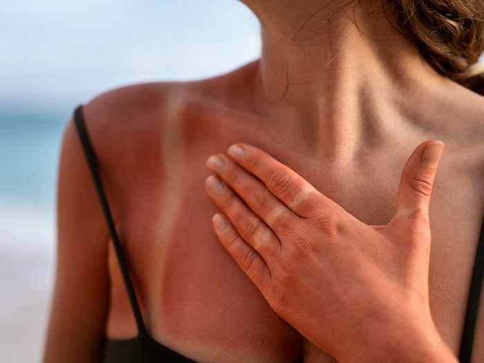 Izgorjeli ste na suncu? Dermatolozi: Odmah uradite...