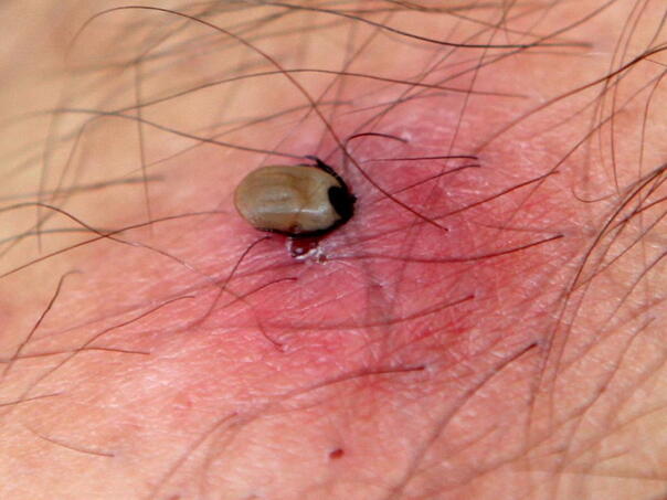 Kako izvaditi krpelja ako ste daleko od ambulante