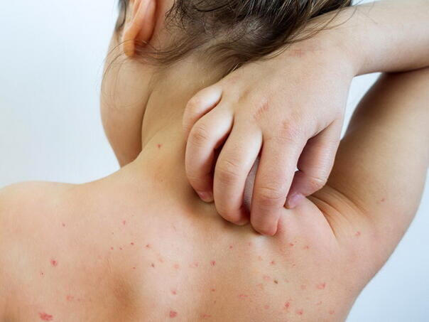 Morbilima u RS zaražene 44 osobe, najviše u Bijeljini i Banjaluci