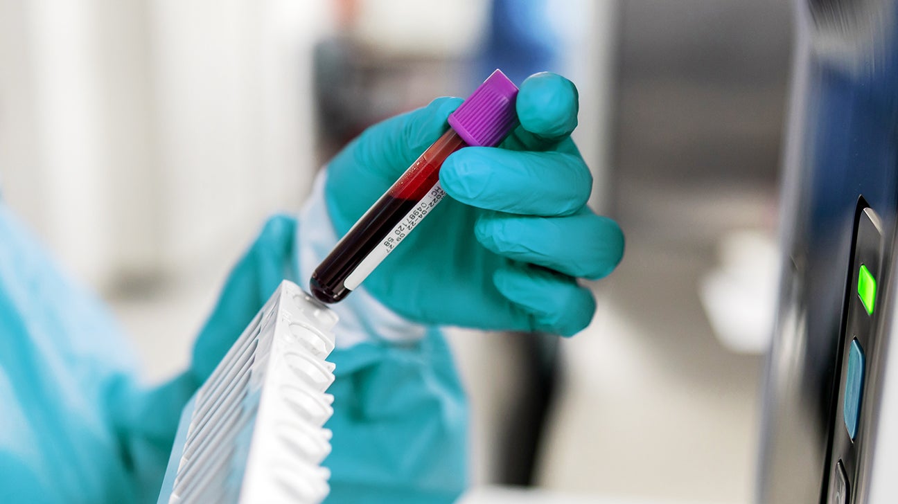 Nauka na pragu čuda: Novi test otkriva rak prije simptoma!?