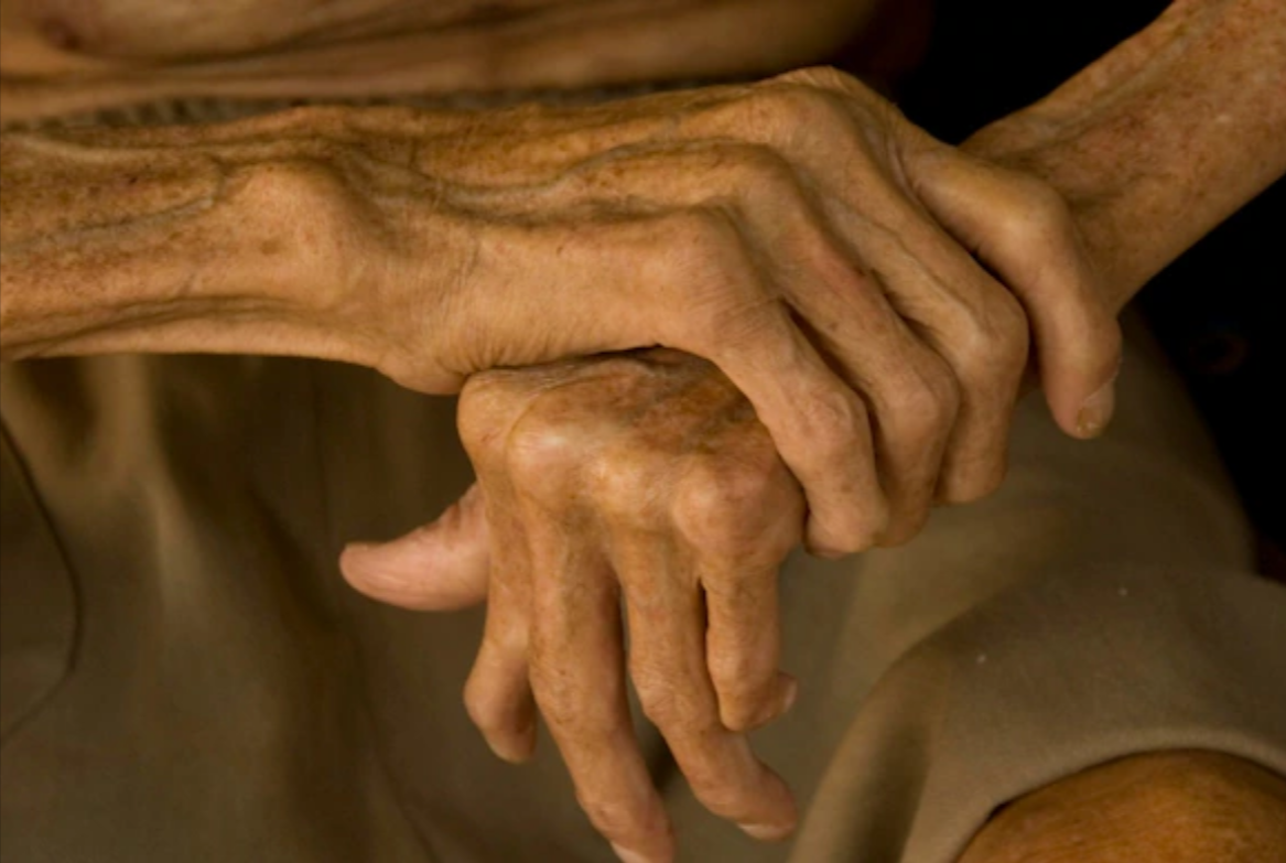 Objavljeno stanje stranog radnika zaraženog leprom u Hrvatskoj