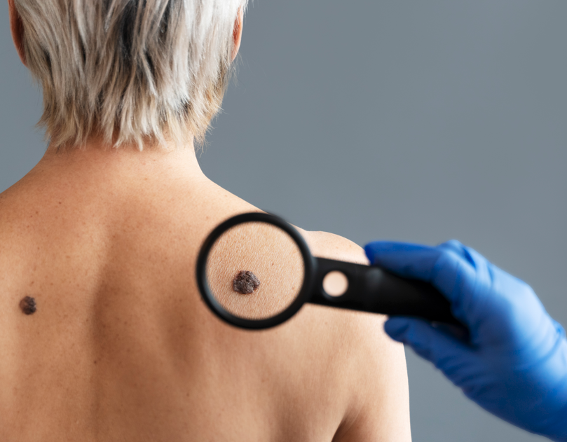 Rusi razvijaju prvi lijek za liječenje melanoma