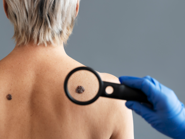 Rusi razvijaju prvi lijek za liječenje melanoma