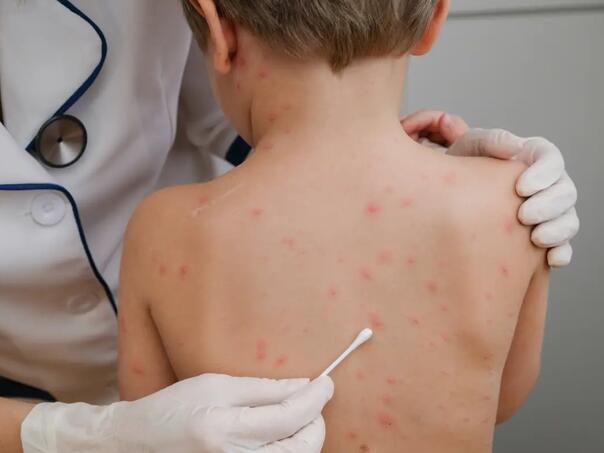 Šuga se širi Hrvatskom: Novi slučajevi u Dubrovačko-neretvanskoj županiji