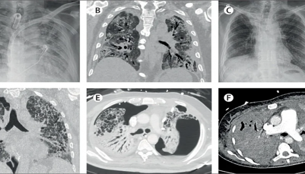 U Beču rade transplantacije pluća kod Covid pacijenata