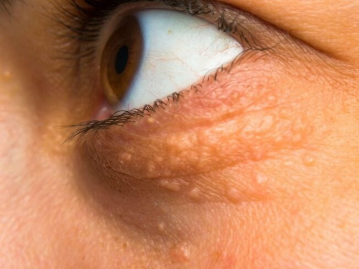 Većina ljudi s nasljedno povišenim holesterolom ne zna da ga ima