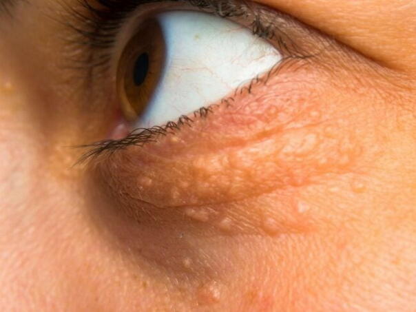 Većina ljudi s nasljedno povišenim holesterolom ne zna da ga ima